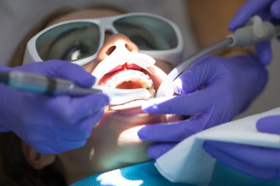 Laser dental treatment