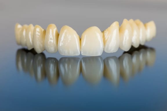 A removable partial denture