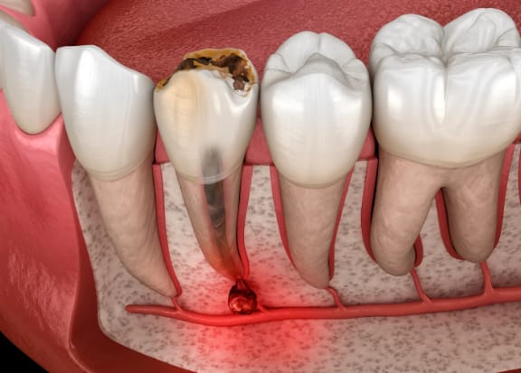 A dental model illustrating tooth decay