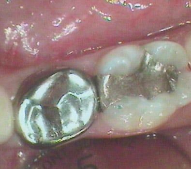 Dental fillings restoring multiple cavities
