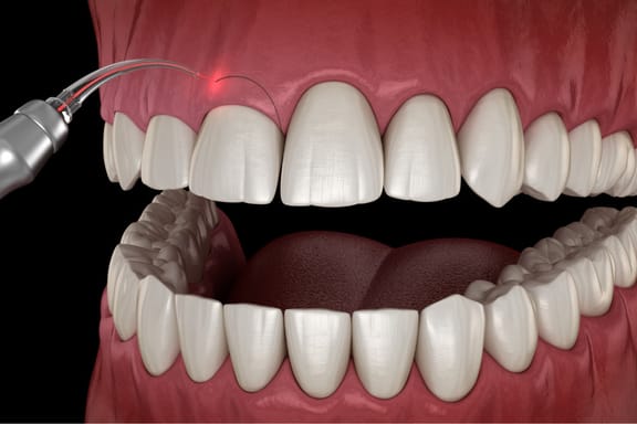 Laser gingivectomy treatment