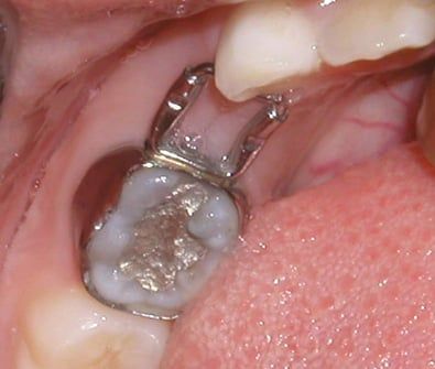 Dental space maintainer