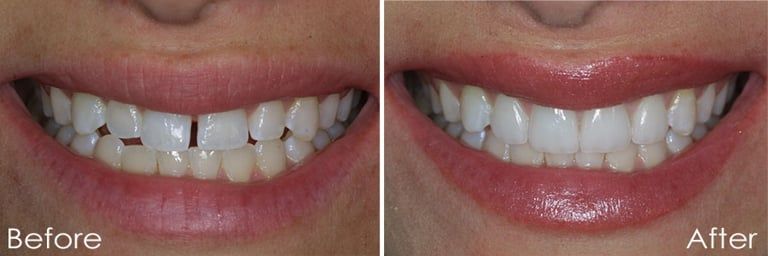 Before-and-after result of porcelain veneers